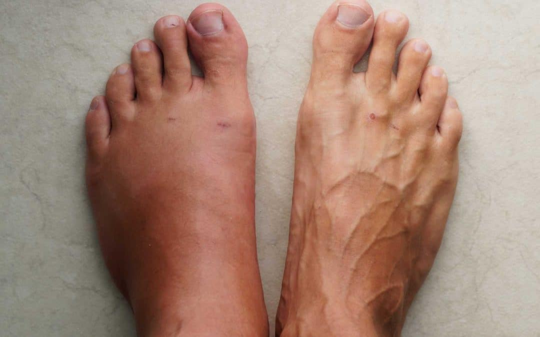 Drenaje linfático para piernas hinchadas en verano por el calor