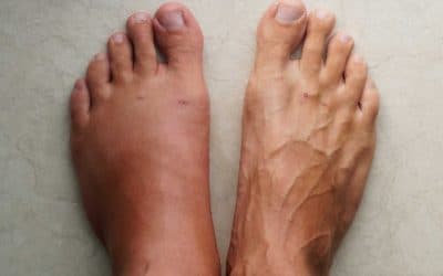 Drenaje linfático para piernas hinchadas en verano por el calor