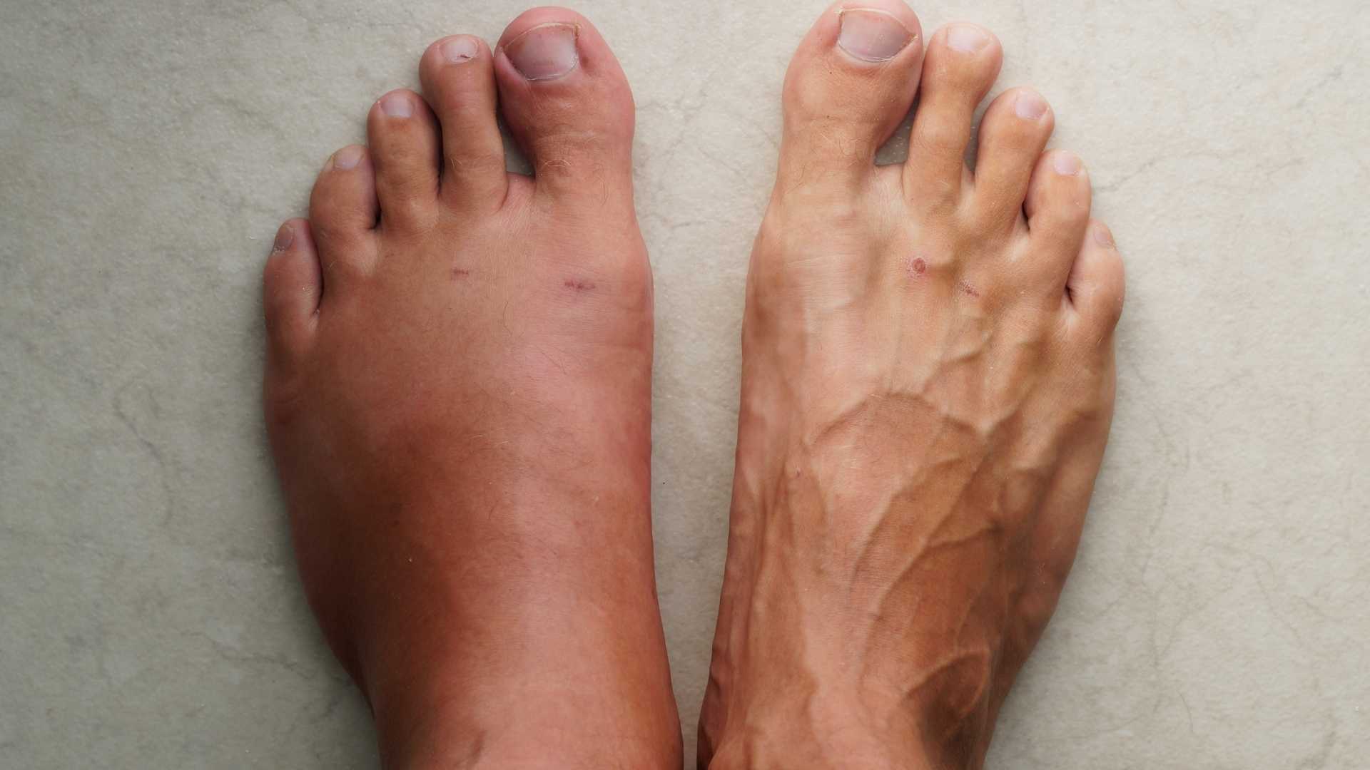 Drenaje linfático para piernas hinchadas en verano por el calor